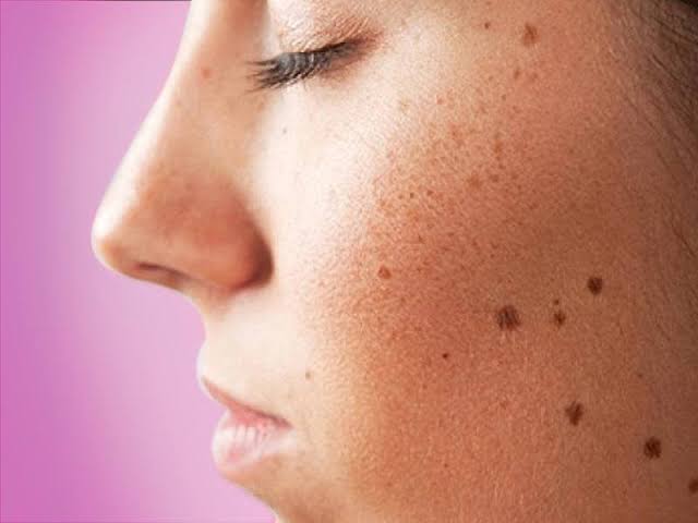 10-best-dark-spots-remover-for-face-reviews-blog