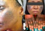 How to know if a cream contains hydroquinone