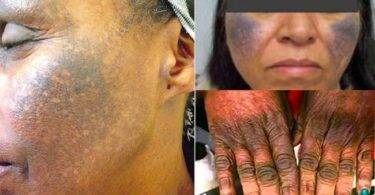 How to know if a cream contains hydroquinone